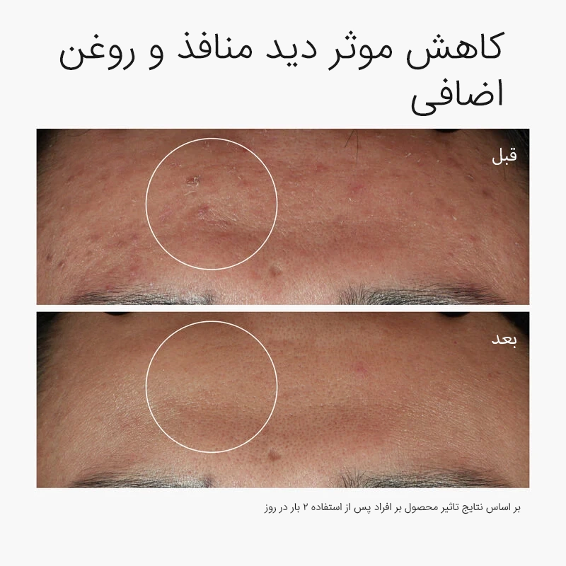 سرم ضد جوش اوردینری نیاسینامید Niacinamide 10% + Zinc 1% اصل