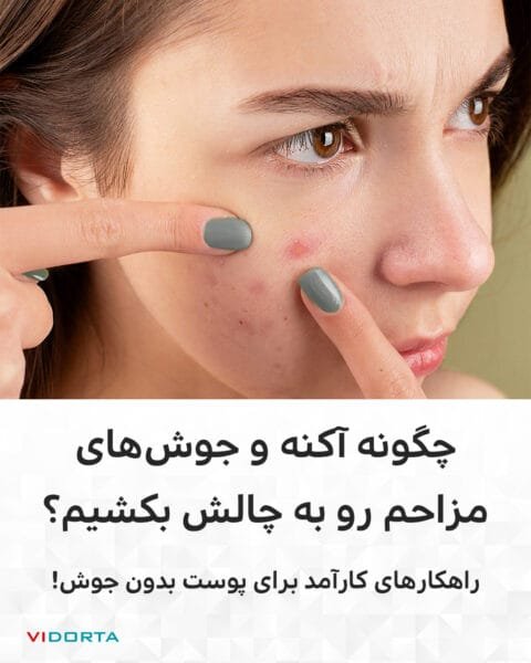 چگونه آکنه و جوش‌های مزاحم رو به چالش بکشیم؟ راهکارهای کارآمد برای پوست بدون جوش!